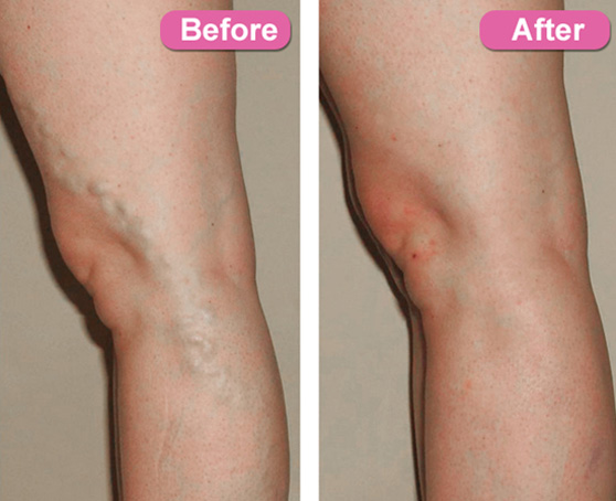 before and after EVLT laser treatment