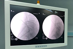 percutaneous laser surgery process