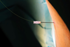 minimally invasive pldd surgery with laser